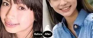 正畸如何吃瓜,轻松吃瓜，健康矫正两不误